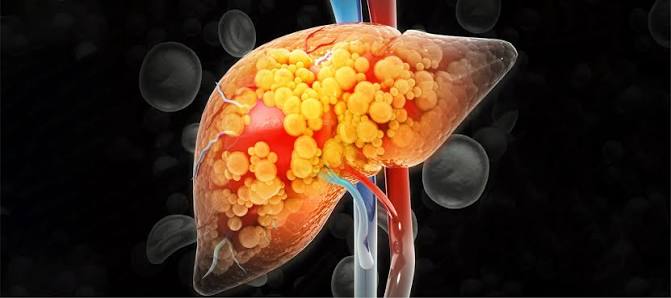 AIIMS Study Reveals Alarming Trends: 38.6% of Adults and 35.4% of Children Affected by Fatty Liver Disease